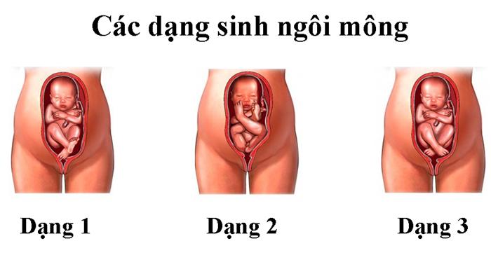5 cách đơn giản giúp mẹ bầu xoay ngôi thai tự nhiên và an toàn