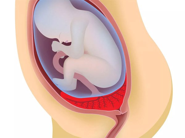 Nhau thai bám thấp cổ tử cung là gì? Cách điều trị và phòng tránh