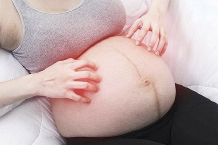 Bị ngứa khi mang thai tháng cuối: nguyên nhân và cách khắc phục