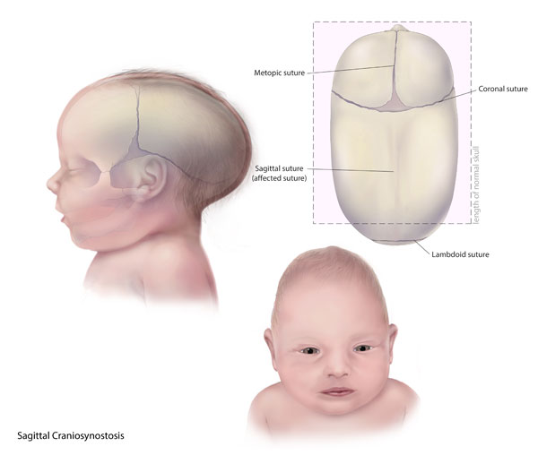 Những điều cần biết về đường gờ khớp sọ ở trẻ sơ sinh
