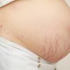 Các loại rạn da khi mang thai và cách điều trị