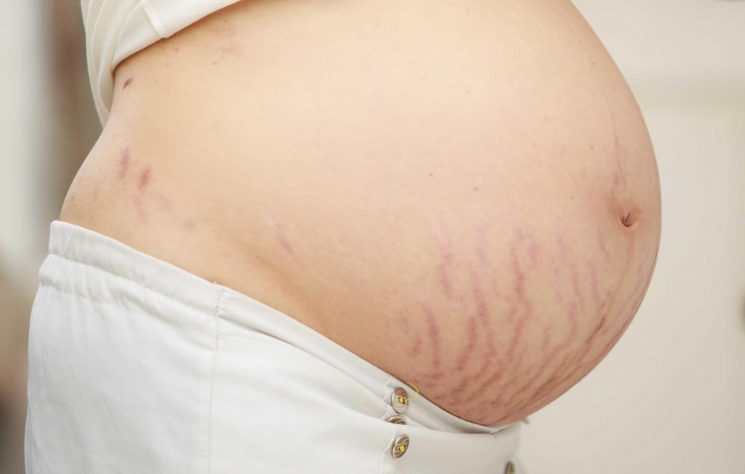 Bôi gì trị ngứa rạn da khi mang thai?