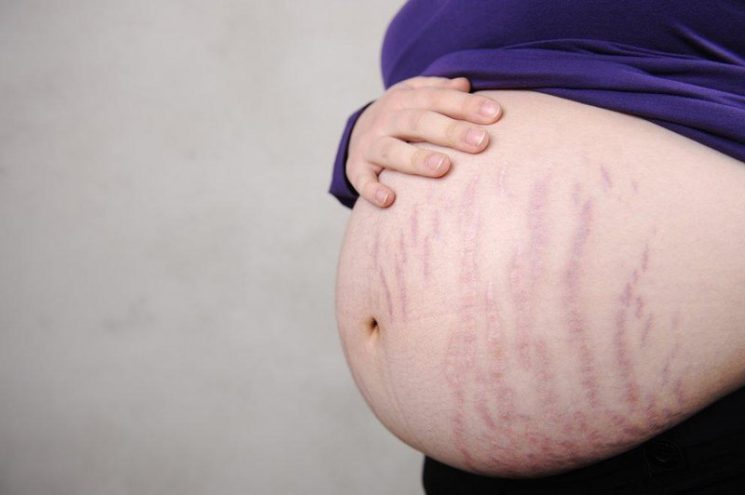Bị rạn da khi mang thai có đau không?