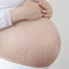 5 cách hạn chế rạn da khi mang thai
