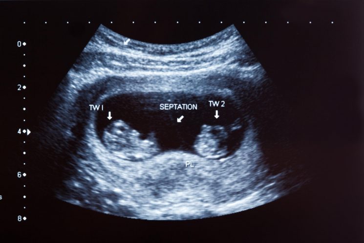 Mang song thai 12 tuần tuổi bé phát triển như thế nào? Những điều mẹ cần lưu ý
