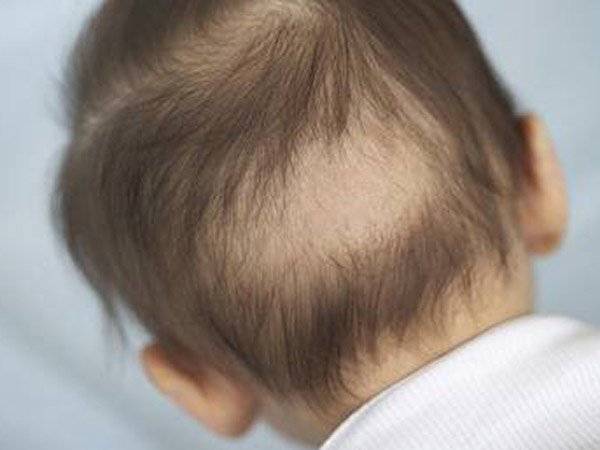 Trẻ thiếu canxi rụng tóc vành khăn đúng hay sai?