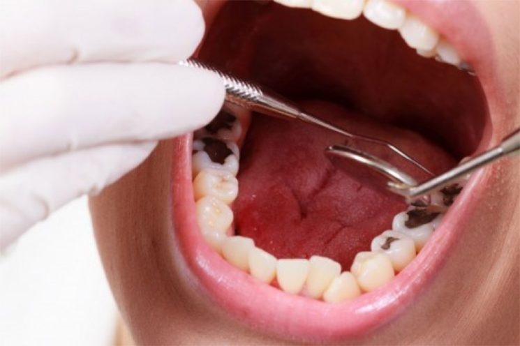Bà bầu bị sâu răng có ảnh hưởng đến thai nhi không?
