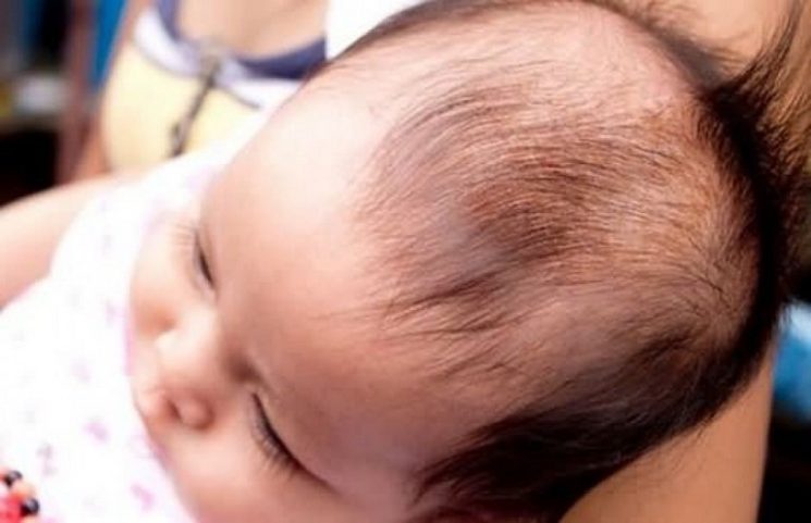 Rụng tóc ở trẻ sơ sinh 3 tháng có phải là bệnh không?