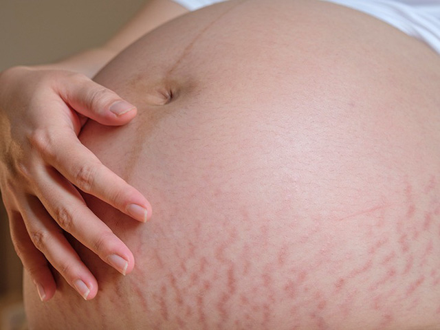 Rạn da sau sinh có chữa được không?