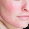 Da mặt bị ngứa khi mang thai có phải dị ứng da mặt không?