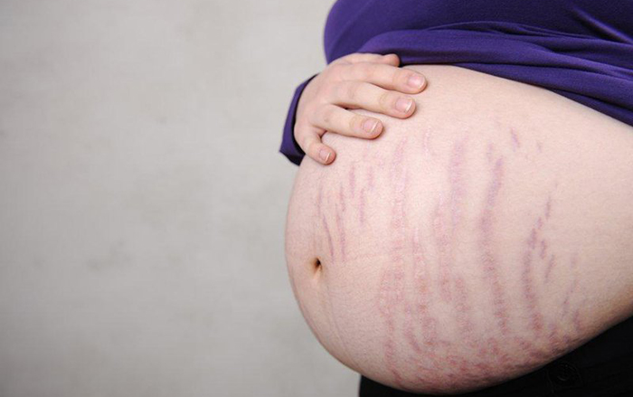 Làm sao để cải thiện tình trạng rạn da ngứa khi mang thai