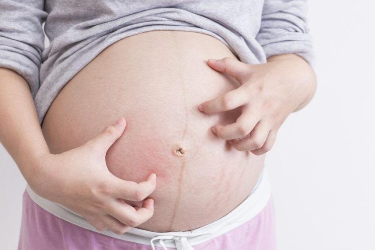 Tại sao bà bầu bị ngứa bụng trong thai kì?