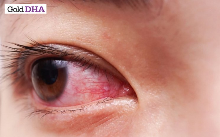 Bà bầu bị đau mắt đỏ bao lâu thì khỏi?