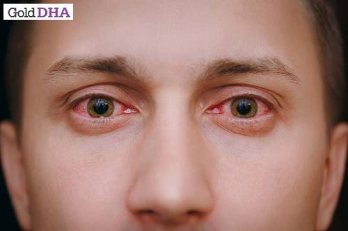 Bà bầu bị đau mắt đỏ kiêng ăn gì?