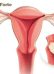 4 lưu ý để phòng tránh sa tử cung sau sinh