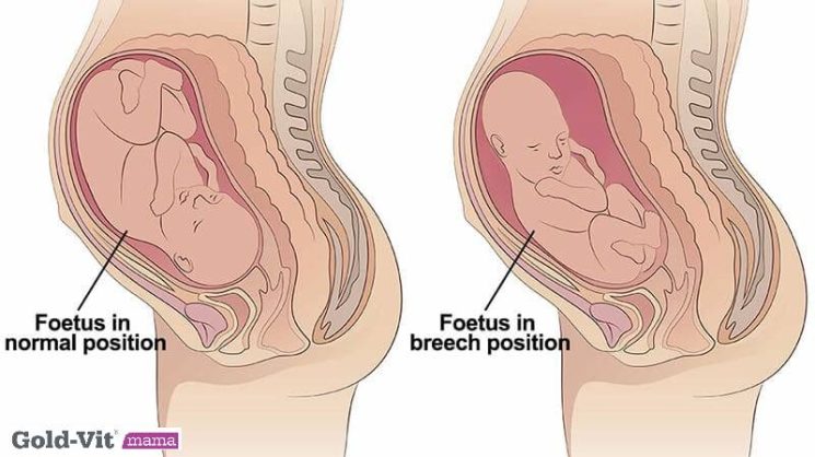 Dấu hiệu chuyển dạ của thai ngôi mông có khác ngôi thai thuận?
