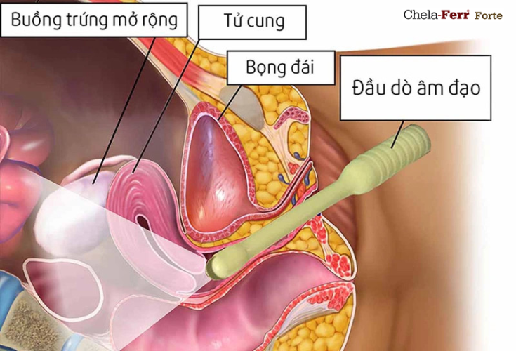 Thai chưa vào tử cung siêu âm đầu dò có thấy không?